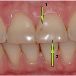 Enamel peels off from an adult’s teeth, what to do?