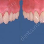 Смещение после удаления зуба