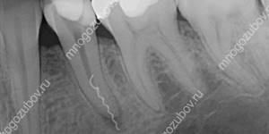 Снимок сломанного инструмента в зубе