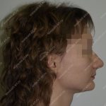 Reduced height of the lower third of the face with distal occlusion