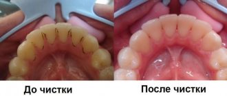 Methods of professional oral hygiene