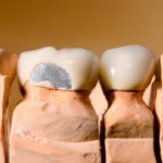 Способы реставрации сколов керамики на коронке