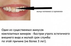 Виниры схема установки
