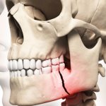 Сроки реабилитации после закрытого остеосинтеза челюсти