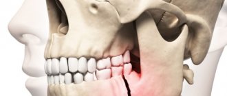 Terms of rehabilitation after closed osteosynthesis of the jaw