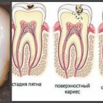 Stages of caries.