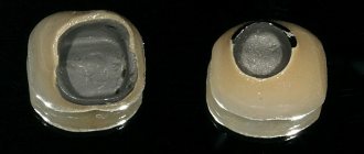 standard abutment