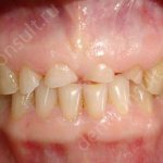 стертые зубы