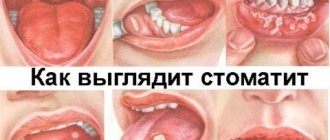 Stomatitis