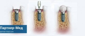 dental implant installation technology