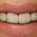 dark spots on teeth - what are they called?