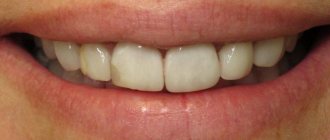 dark spots on teeth - what are they called?