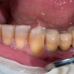 тетрациклиновые зубы у человека