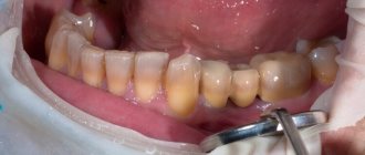 тетрациклиновые зубы у человека