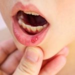 Types of stomatitis in a child and how to treat it