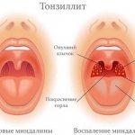 Tonsillitis