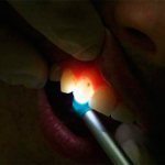 Трансиллюминирование - метод диагностики кариеса, когда зуб освещается очень ярким точечным источником света.