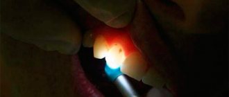 Transillumination is a method for diagnosing caries when the tooth is illuminated with a very bright point source of light.