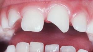 травма постоянных зубов у детей