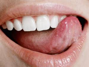 Травмирование слизистой языка горячими жидкостями — типичное бытовое повреждение