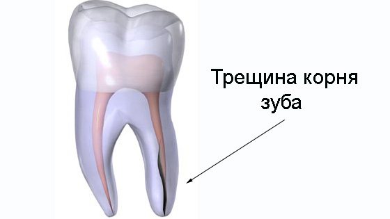 Трещина корня зуба