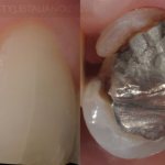 трещина зуба