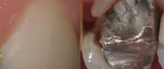 трещина зуба
