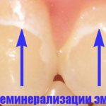 Участки деминерализации эмали зубов
