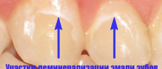 Areas of demineralization of tooth enamel
