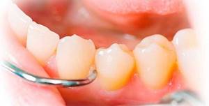 Удаление кисты зуба: виды патологии, способы устранения