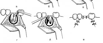 Removing the roots of the lower molar using a drill and an angular elevator