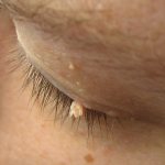 Removal of papillomas - which methods are better?