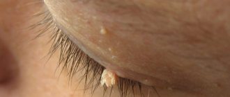 Удаление папиллом — какие способы лучше?