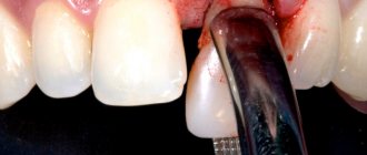 удаление переднего зуба