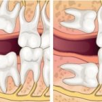 Удаление ретинированного дистопированного зуба