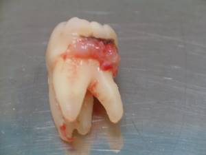Удаление зуба с кистой: больно или нет