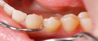 Remove the tooth