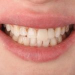 Lengthening the crown of a tooth
