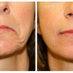 corners of lips down