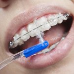Уход за брекет-системами из пластмассы