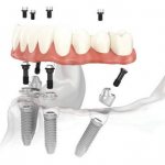 Установка абатментов