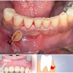 установка дренажа в десну