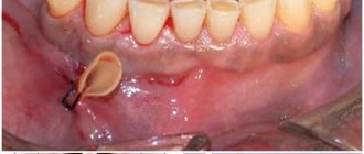 установка дренажа в десну