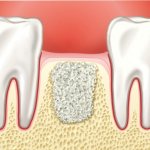 Усугубление атрофии