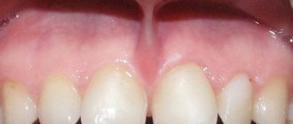 Upper lip frenulum