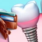 Важные аспекты при оформлении налогового вычета при имплантации зубов