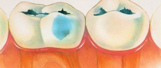 The progression of caries in a decompensated form is very dangerous and often associated with various complications...