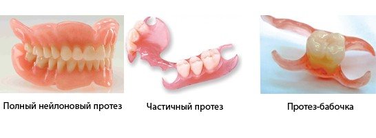 Виды имплантов зубов при адентии
