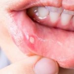 Виды язв, как выглядят, симптомы, причины, методы лечения