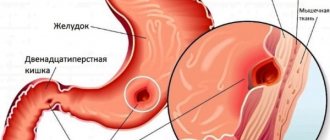 Vinilin (Shostakovsky balm). Instructions for use, price, reviews, analogues